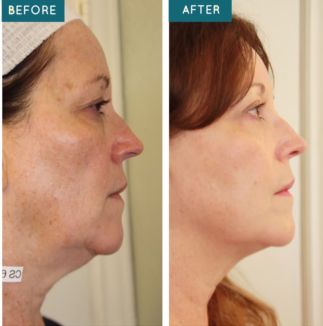 Before and after combination therapy at Neoderma Anaheim: Connie S. side profile — reduced sun spots, smoother skin, and a firmer, more defined jawline and chin