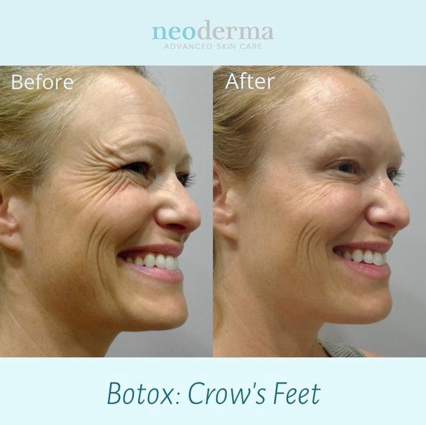 Before and after Botox on crow's feet at Neoderma Anaheim — softened lines with natural expression