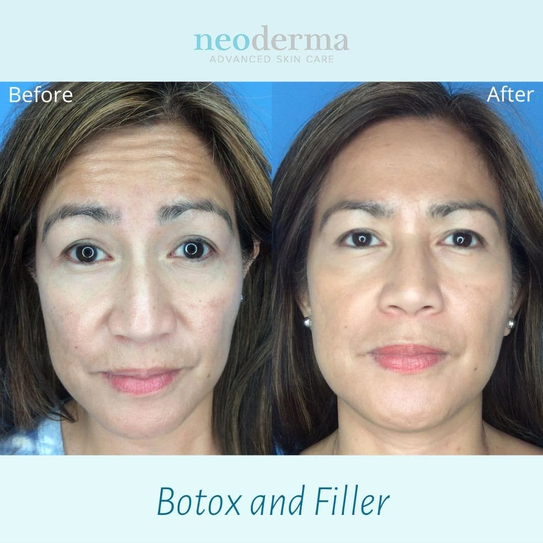 Before and after Botox and dermal filler combination treatment at Neoderma Anaheim: smile lines softened and midface volume restored