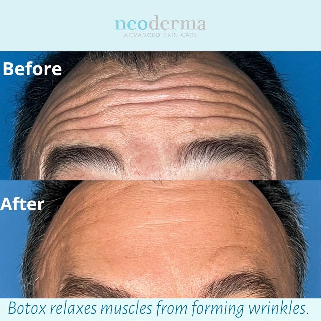 Male patient at Neoderma Anaheim before and after Botox: deep horizontal forehead lines softened while the brow stays low, flat, and level