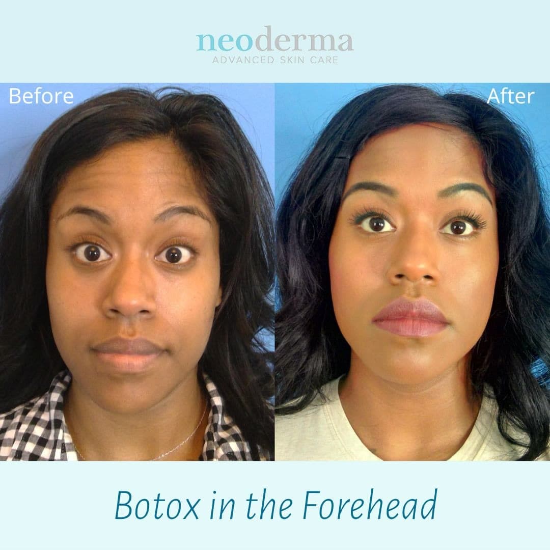 Before and after Botox on forehead lines at Neoderma Anaheim