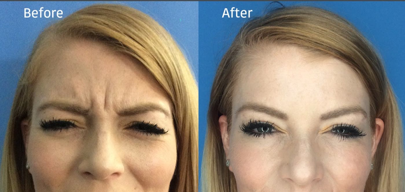 Before and after Botox on frown lines between the brows