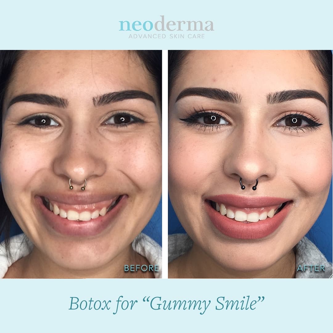 Before and after Botox for a gummy smile at Neoderma Anaheim: a natural, balanced smile line