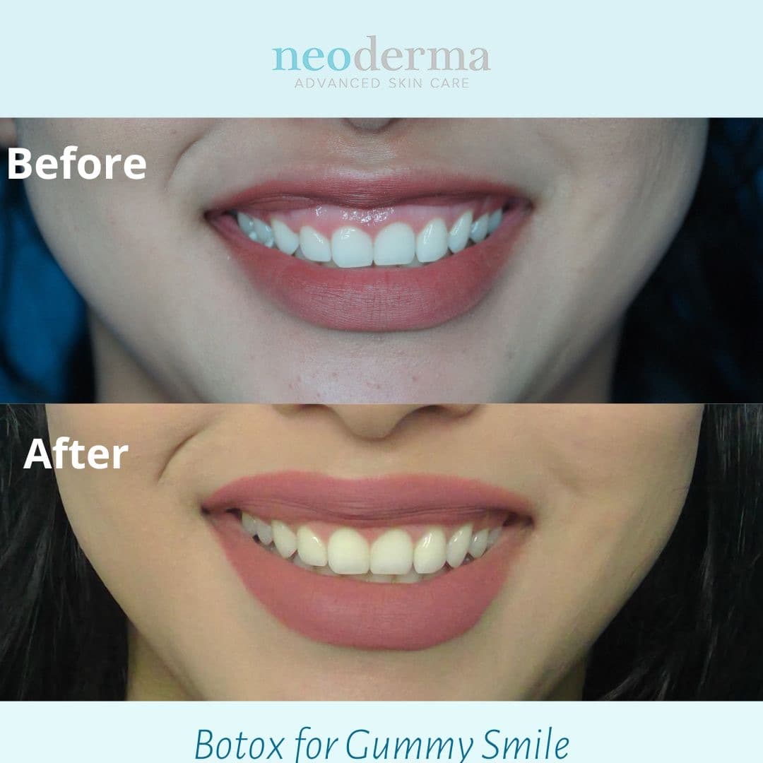 Before and after Botox for a gummy smile at Neoderma Anaheim: less gum shows for a balanced smile