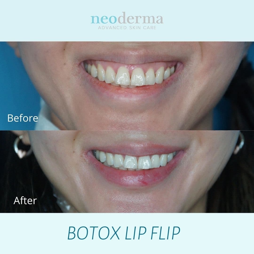 Before and after a Botox lip flip at Neoderma Anaheim: the upper lip rolls slightly outward to show more pink, with no added volume