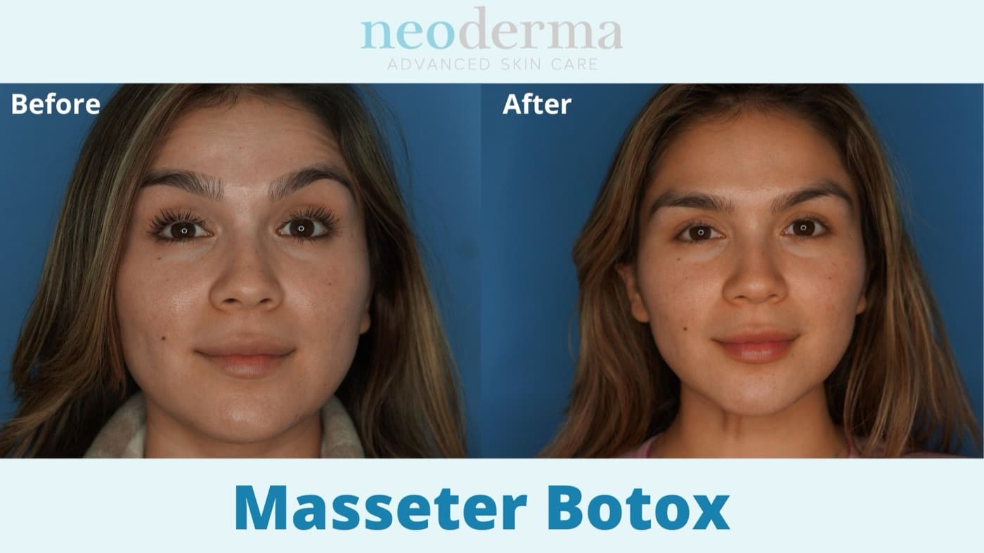Before and after masseter Botox: a slimmer, more contoured jawline