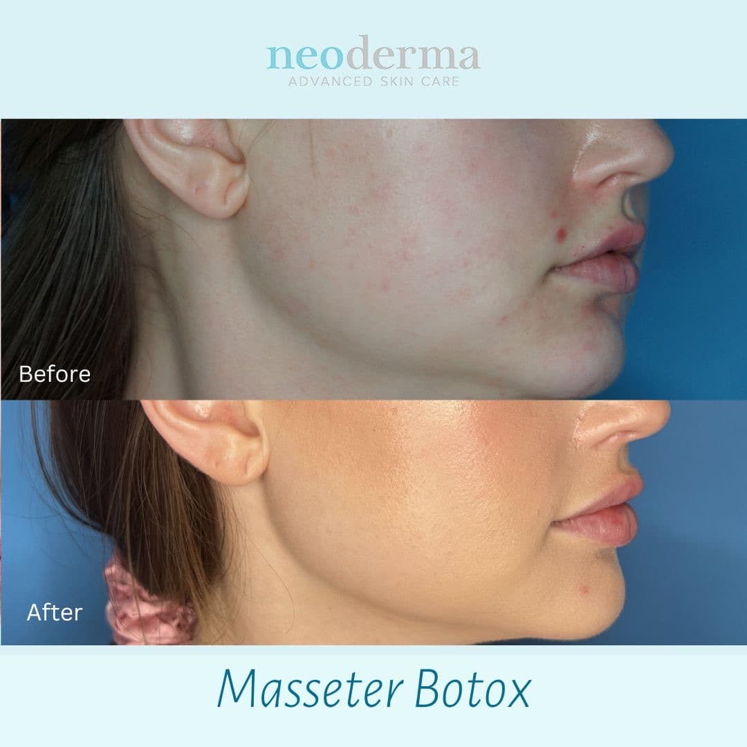 Before and after masseter Botox at Neoderma Anaheim (profile view): a more contoured jawline