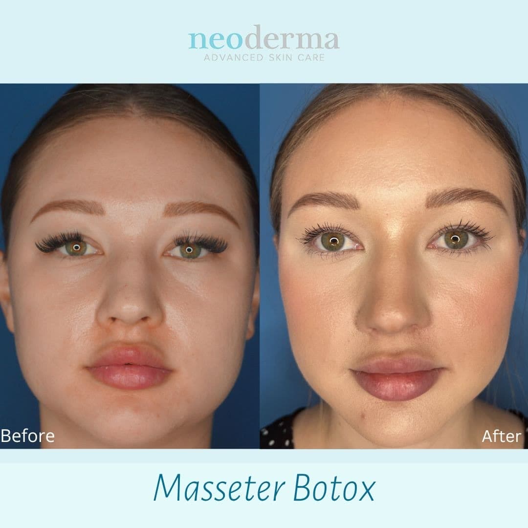 Before and after masseter Botox at Neoderma Anaheim: jawline visibly slimmed and contoured