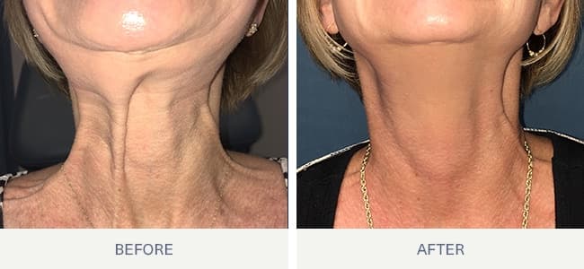 Before and after Botox for platysmal neck bands at Neoderma Anaheim — softened vertical cords in the neck