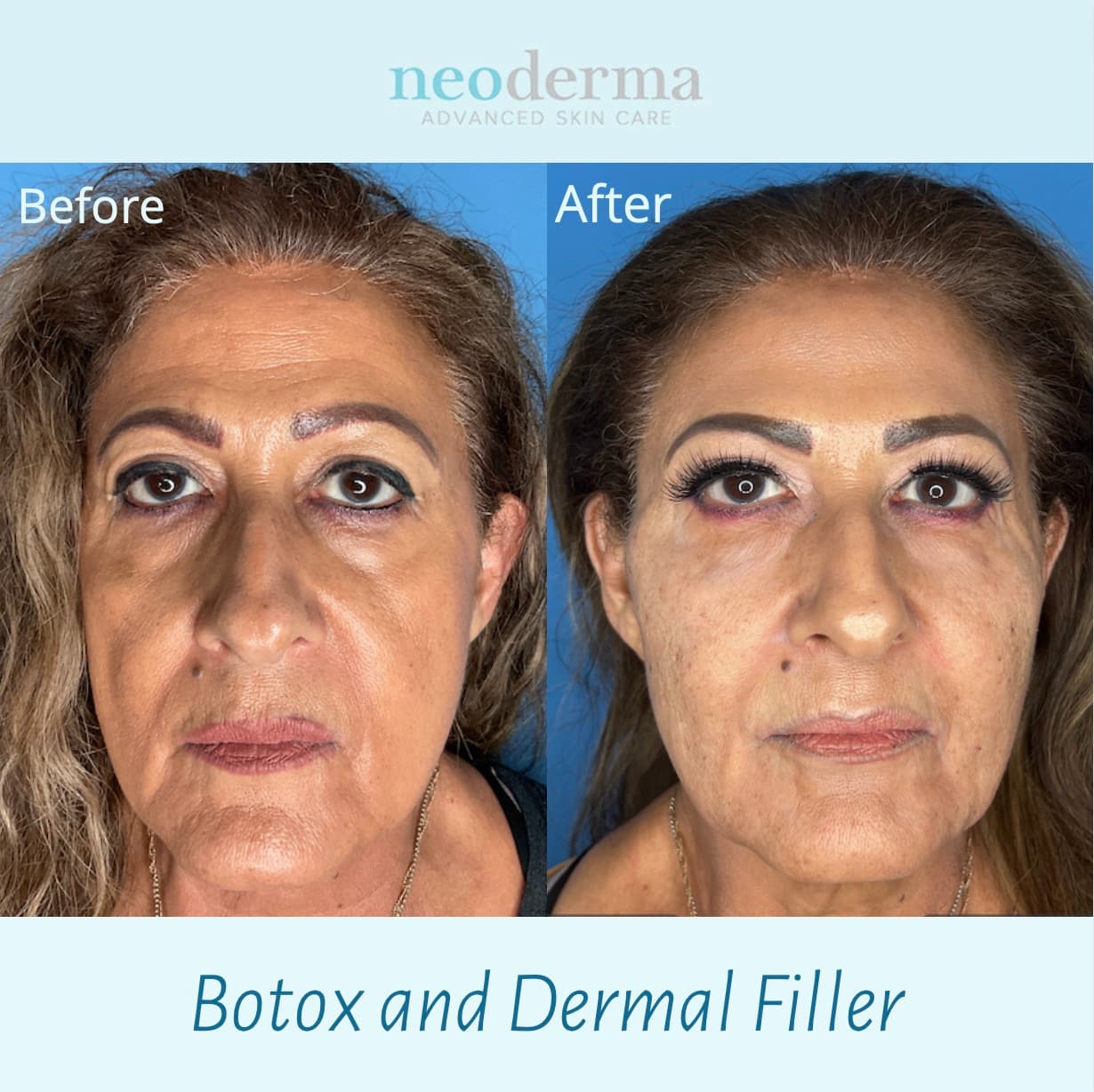 Before and after dermal filler and Botox at Neoderma Anaheim: restored facial volume and softened lines