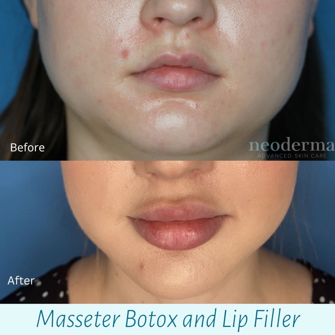 Before and after lip filler with masseter Botox at Neoderma Anaheim: fuller lips and a slimmer jaw