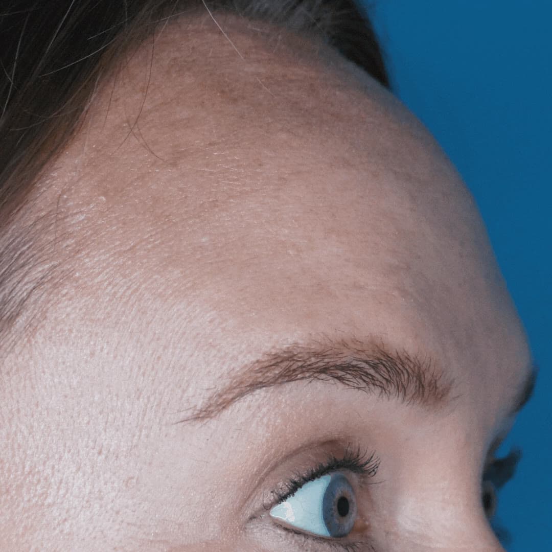 Smooth, refreshed forehead after Botox at Neoderma Anaheim
