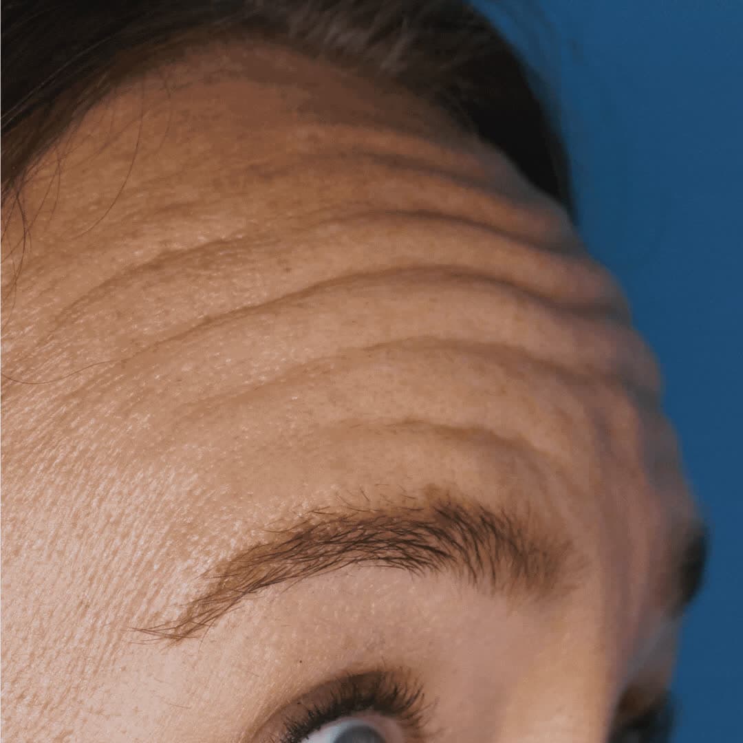 Before Botox at Neoderma Anaheim: deep horizontal forehead lines while raising the brows