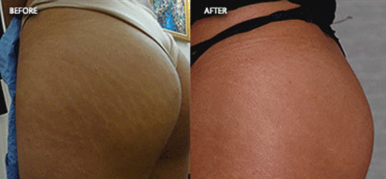 Reduced cellulite after carboxytherapy at Neoderma Anaheim