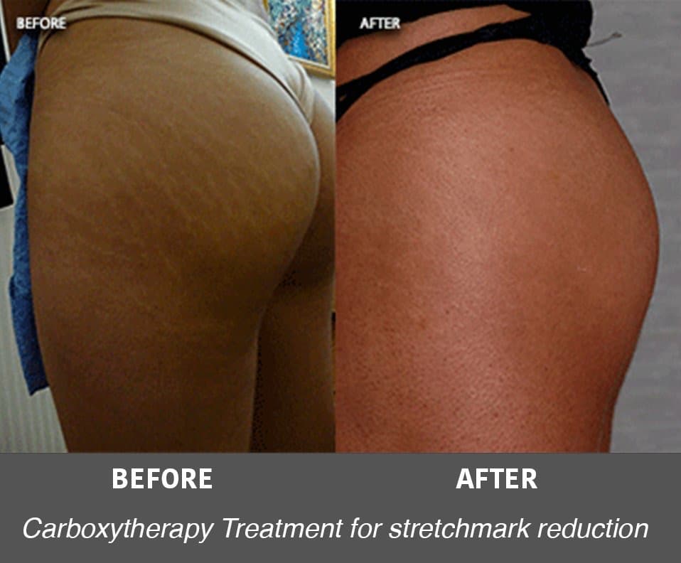 Before and after carboxytherapy for stretch marks at Neoderma Anaheim — visibly faded, smoother stretch marks