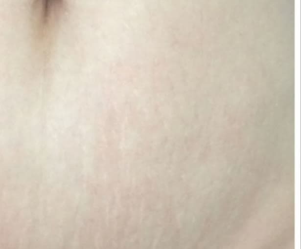 Smoother skin after carboxytherapy at Neoderma Anaheim