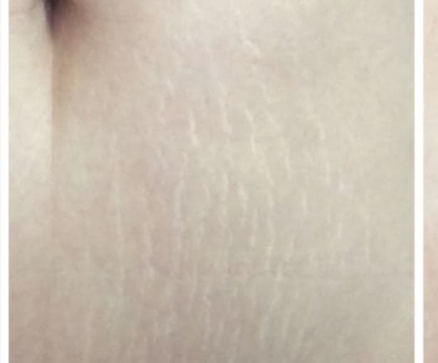 Before carboxytherapy at Neoderma Anaheim: visible stretch marks on the stomach