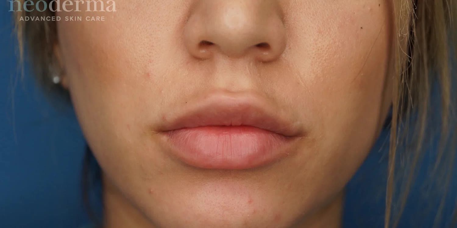 Fuller, balanced lips after dermal filler at Neoderma Anaheim