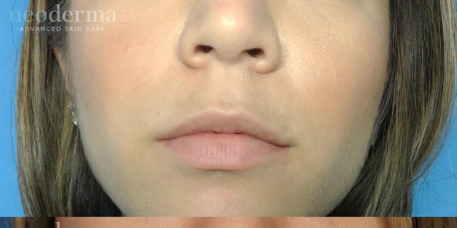 Before lip filler at Neoderma Anaheim: naturally thin lips prior to Juvéderm treatment