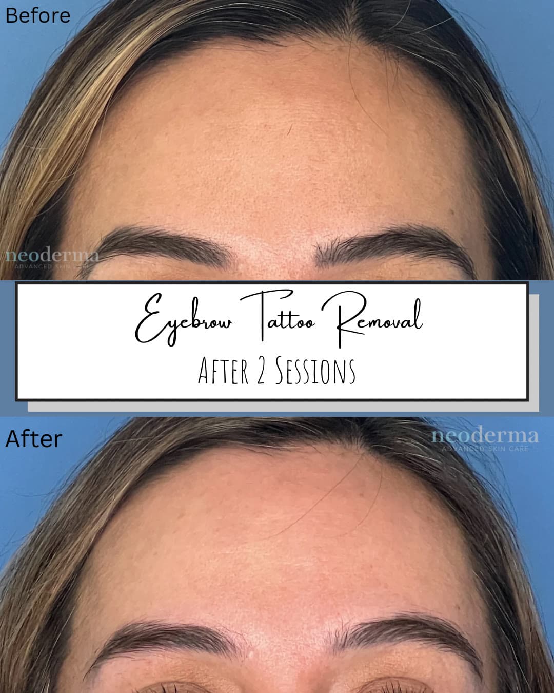 Before and after eyebrow tattoo removal at Neoderma Anaheim after 2 sessions