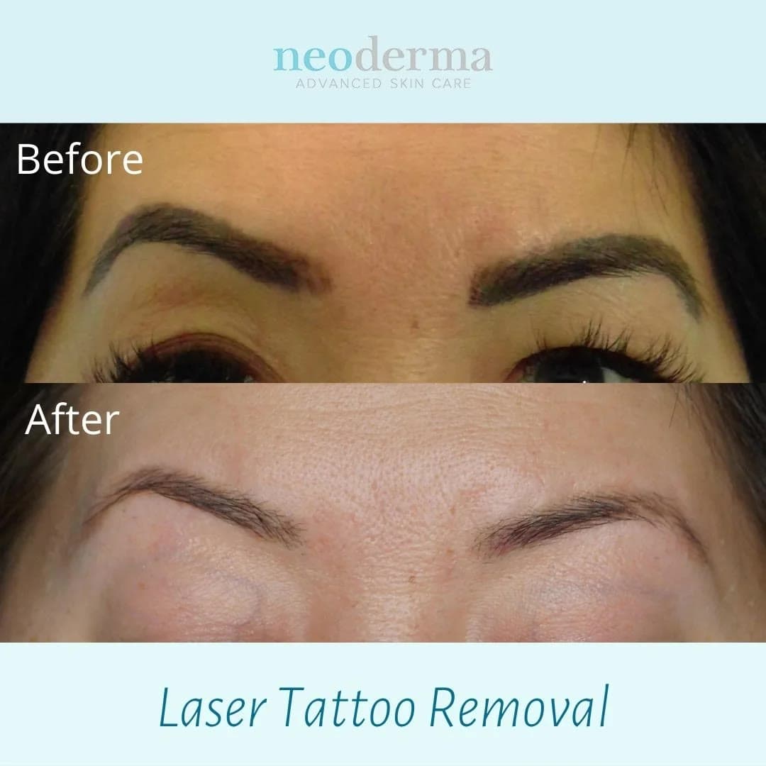 Before and after eyebrow tattoo removal at Neoderma Anaheim: dark tattooed brows removed with PicoWay for a soft, natural result