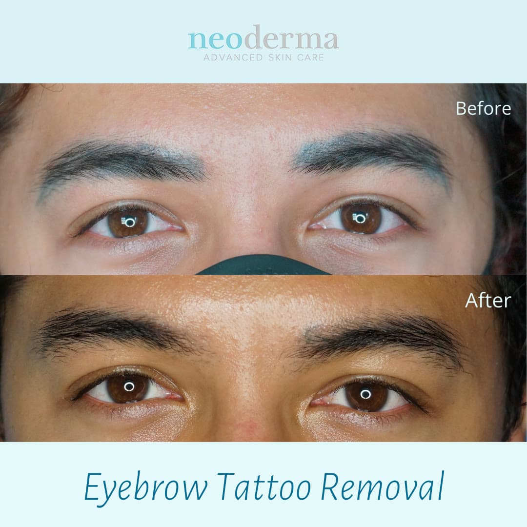 Before and after microblading removal at Neoderma Anaheim: faded blue-grey brow pigment fully cleared with PicoWay, natural brow hair intact