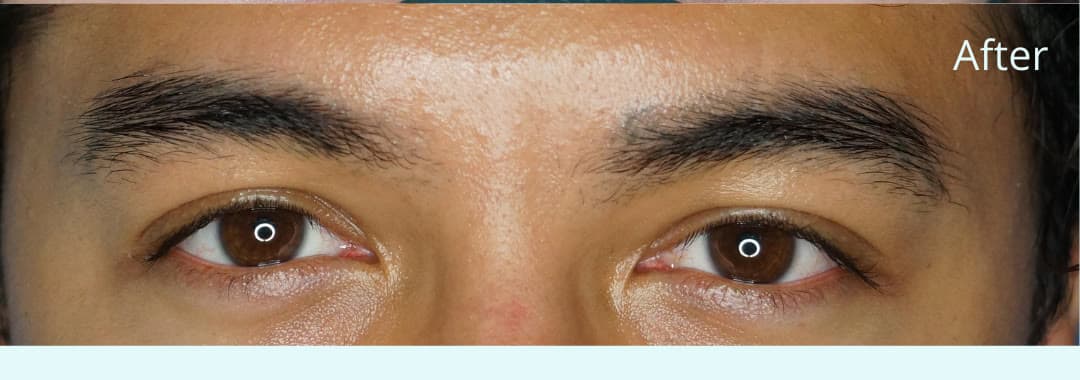 Natural brows after eyebrow tattoo removal at Neoderma Anaheim