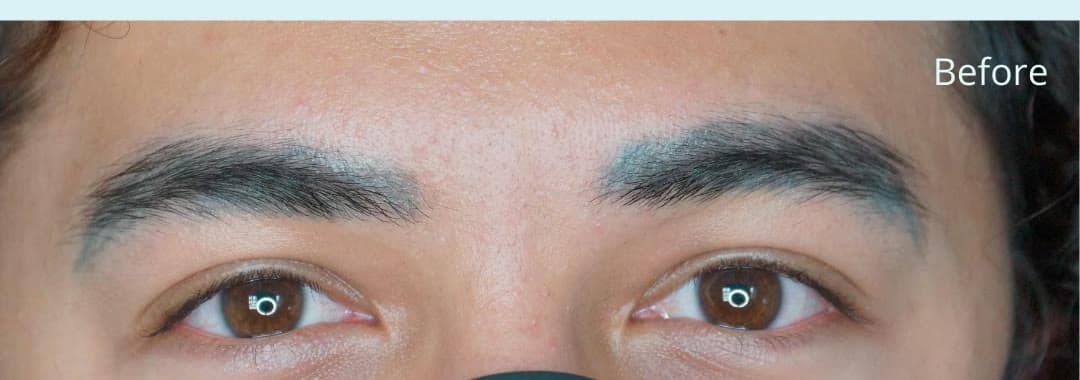 Before eyebrow tattoo removal at Neoderma Anaheim: brows with faded blue-grey tattoo pigment
