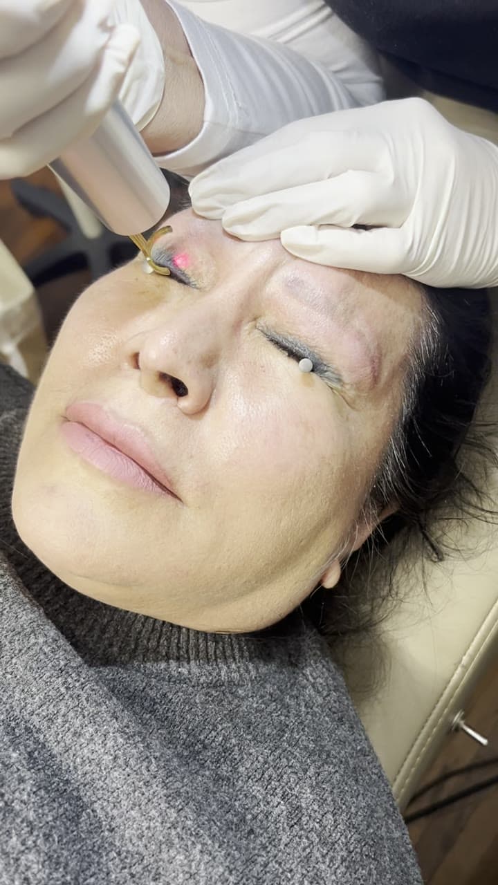 Eyeliner tattoo removal at Neoderma Anaheim: medical-grade protective eye shields covering the eye before a PicoWay pass along the lash line