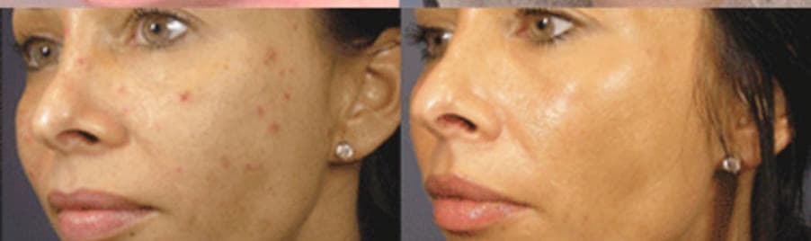 Before and after a peel and facial treatment plan at Neoderma Anaheim: sun damage and breakouts cleared, tone evened and glowing