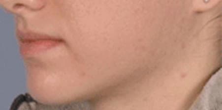 Clear skin after an anti-acne facial at Neoderma Anaheim