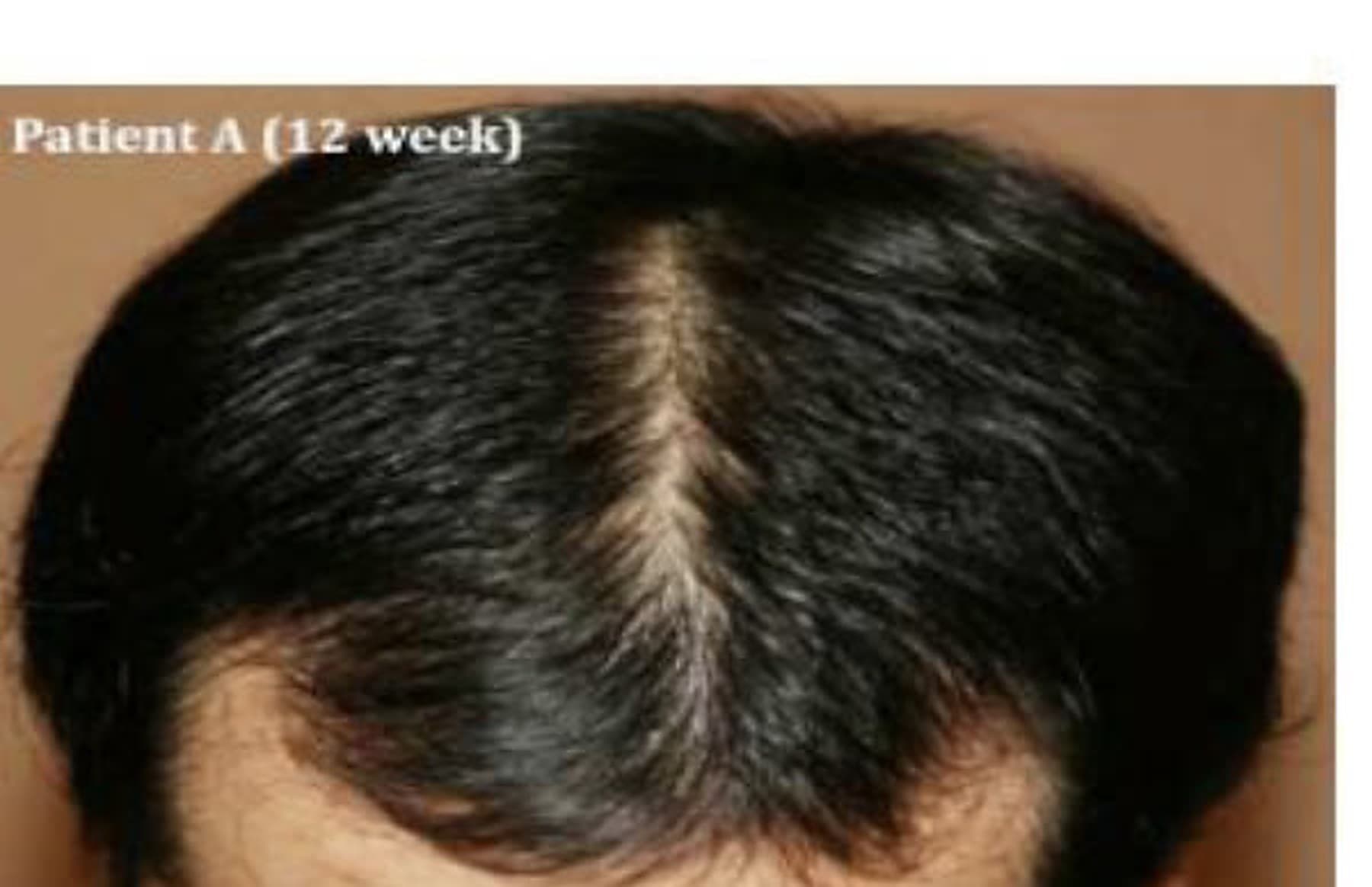 After 12 weeks of hair restoration: denser, fuller crown coverage