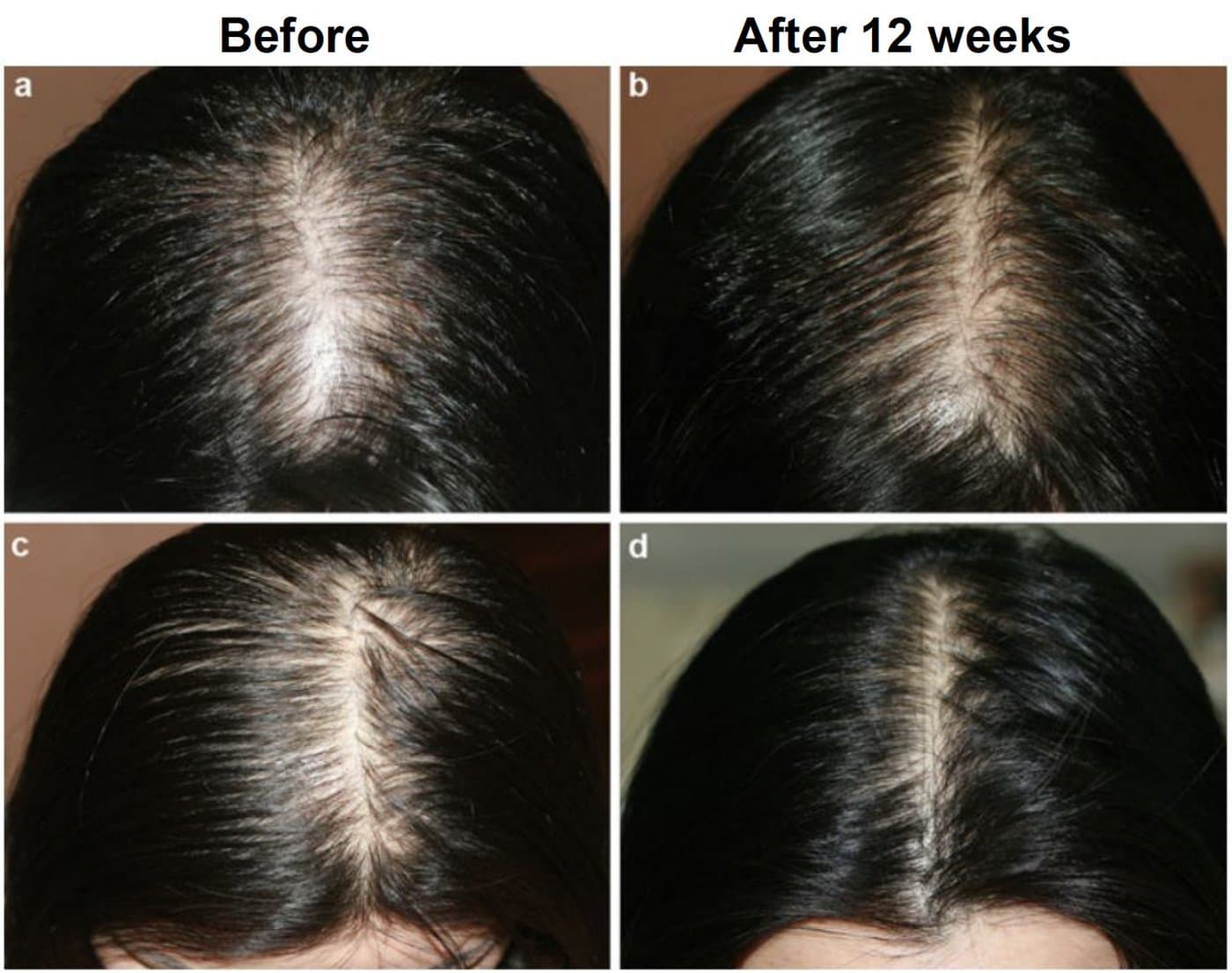 Before and after non-surgical hair restoration for a female patient at Neoderma Anaheim — visibly denser hair