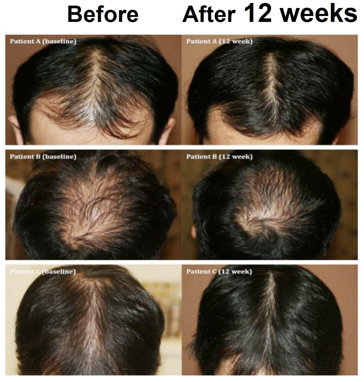 Before and after 12 weeks of hair restoration in three male patients: denser crown and hairline coverage