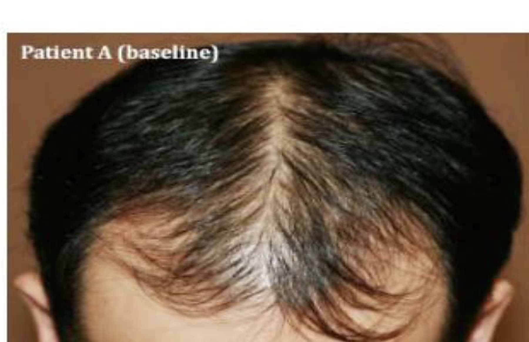 Before hair restoration: thinning crown with visible scalp