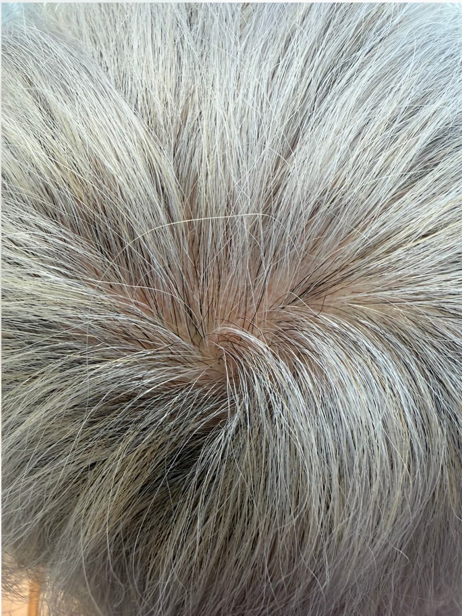 Cynthia's crown after hair restoration at Neoderma Anaheim — noticeably denser coverage with far less scalp showing through