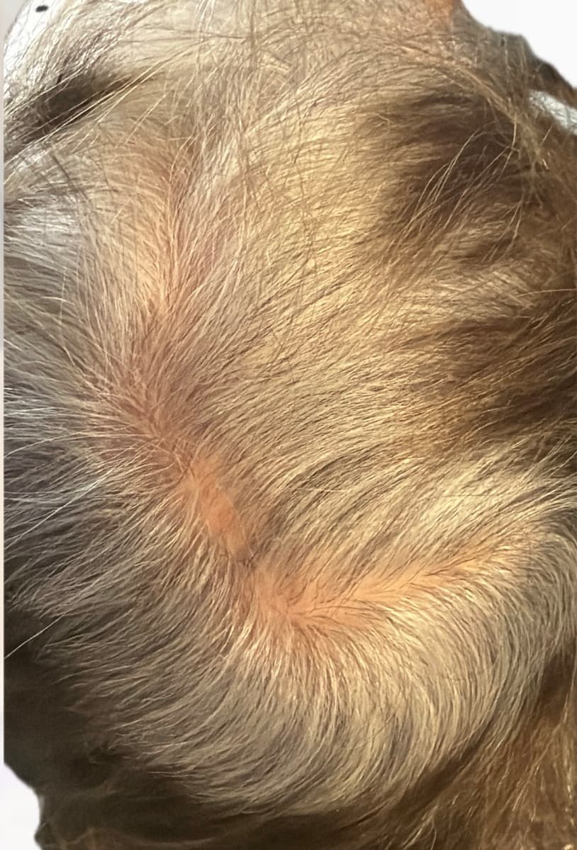 Cynthia's crown before hair restoration at Neoderma Anaheim — visible scalp and reduced density through the part and crown