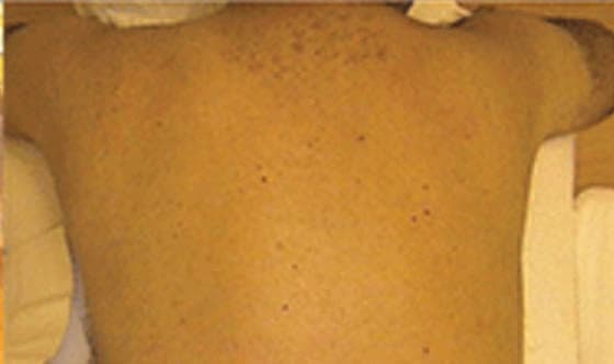 Smooth, hair-free skin after laser hair removal at Neoderma Anaheim