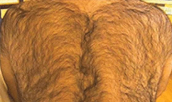 Before laser hair removal at Neoderma Anaheim: man's upper back covered in dense dark hair