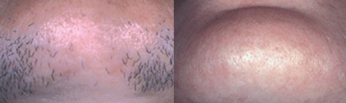Before and after laser hair removal on the chest at Neoderma Anaheim: coarse dark hair cleared to smooth skin