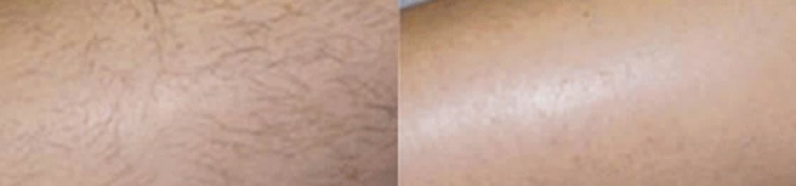 Smooth, hair-free legs after a laser hair removal series — started in fall, finished by spring