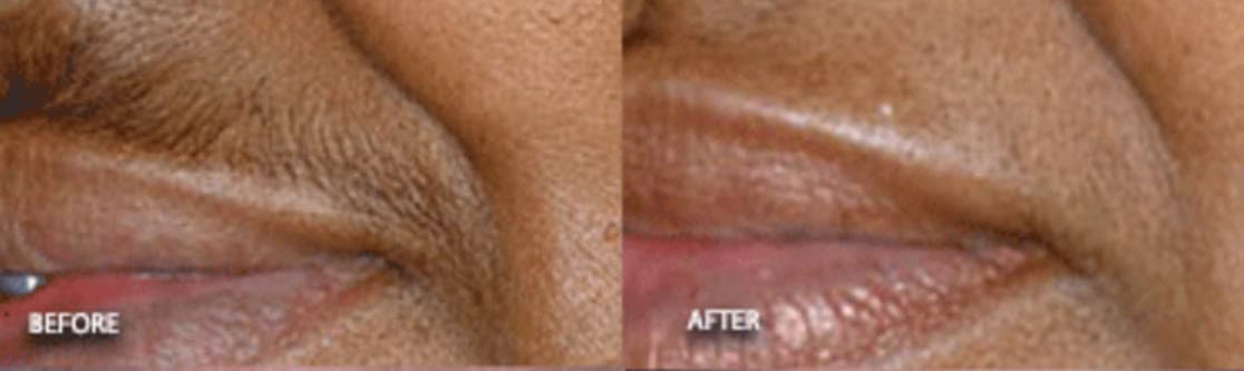Before and after laser hair removal on the upper lip at Neoderma Anaheim, shown on deeper skin — safe for all skin tones