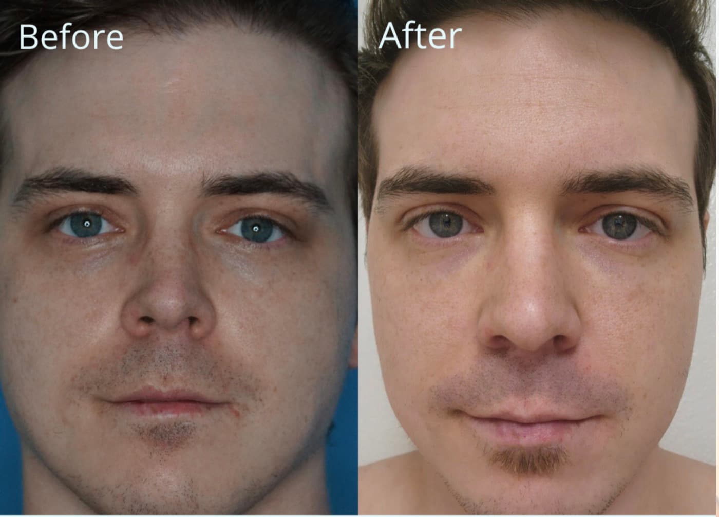 Before and after laser resurfacing with dermal filler at Neoderma Anaheim: clearer, smoother skin and a refreshed contour