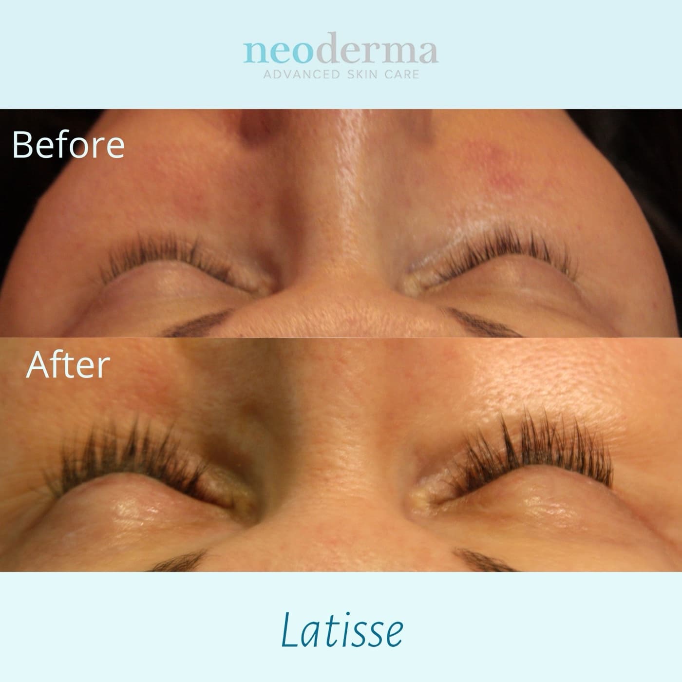Before and after Latisse on a Neoderma Anaheim patient: eyelashes grow visibly longer, fuller, and darker with nightly use