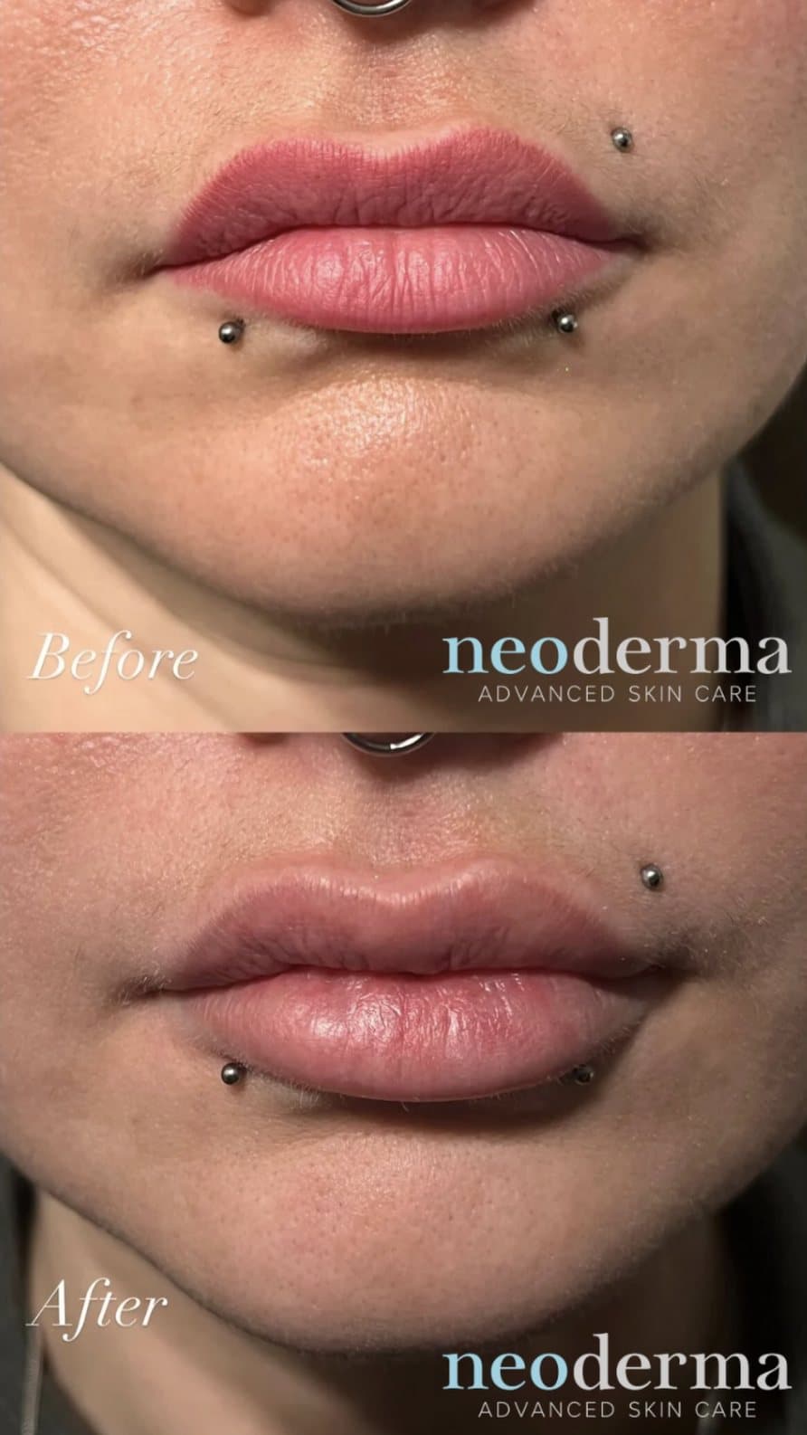 Before and after lip blush tattoo removal at Neoderma Anaheim — saturated, over-drawn permanent lip pigment cleared back to a natural lip colour and border