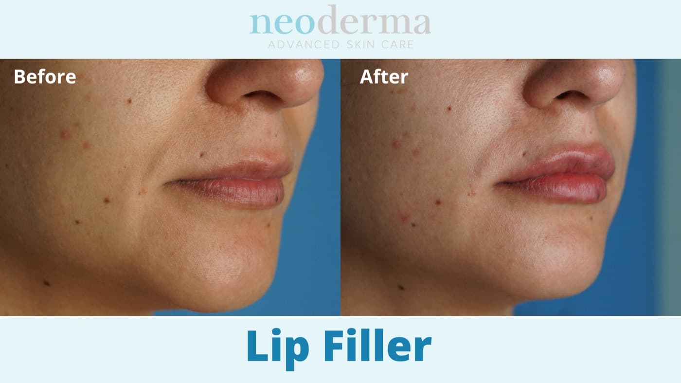 Before and after natural-looking lip filler at Neoderma Anaheim — subtle shape and definition, not volume
