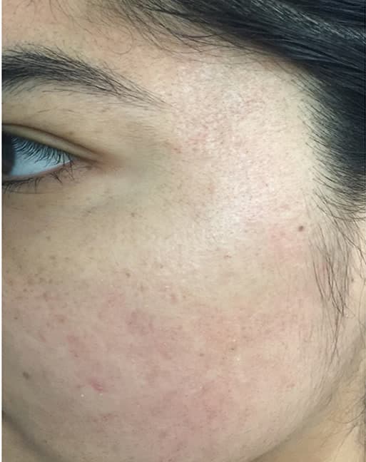 After a Secret RF microneedling series at Neoderma Anaheim: acne and breakouts cleared to smooth, calm, even skin
