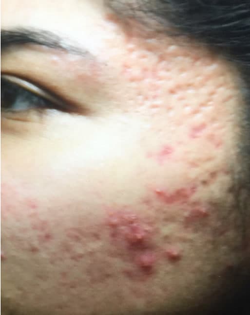 Before Secret RF microneedling at Neoderma Anaheim: cheek with inflammatory acne, active breakouts, and uneven, scarred texture