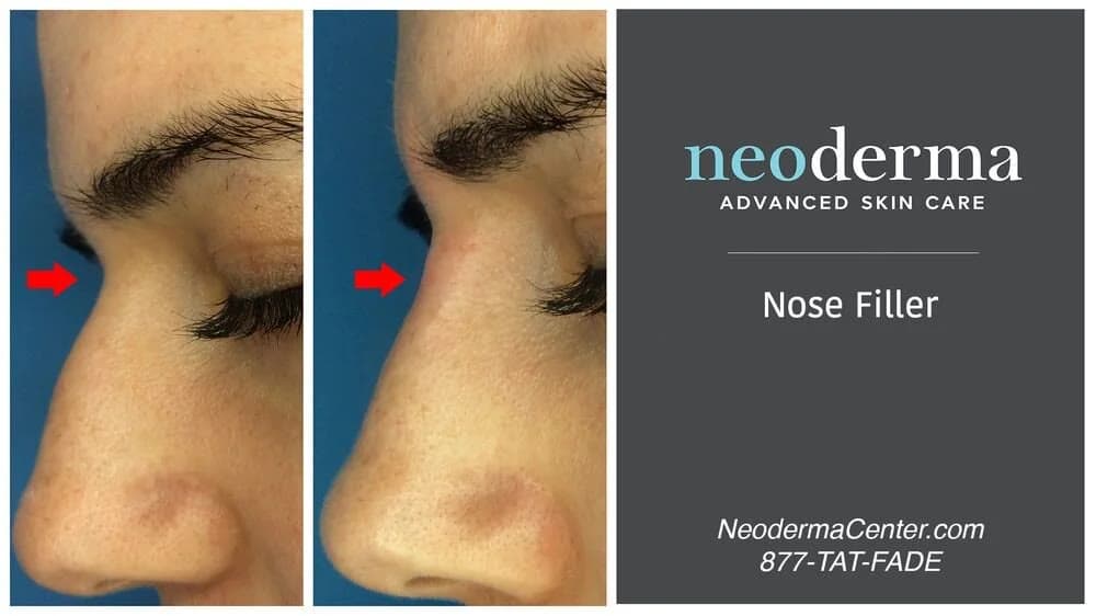 Refreshed under-eye area after filler at Neoderma Anaheim