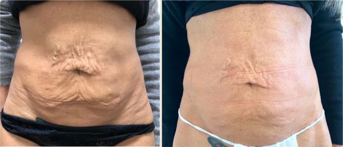 Before and after ONDA Coolwaves body contouring on the abdomen at Neoderma Anaheim: smoother, tighter stomach contour with reduced skin laxity